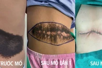 Mổ 2 lần lấy khối u sắc tố bẩm sinh khổng lổ cho trẻ 8 tuổi