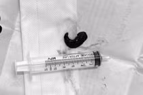 Uống nước suối, người đàn ông bị con vắt sống 3 tháng trong khí quản 