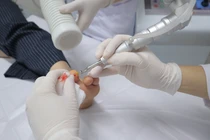 Ứng dụng công nghệ laser CO2 điều trị một số bệnh da liễu