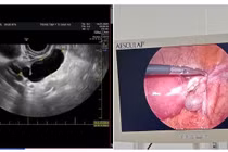 Đau hạ vị kéo dài không ngờ ứ mủ vòi trứng, viêm phúc mạc