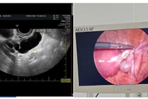 Đau hạ vị kéo dài không ngờ ứ mủ vòi trứng, viêm phúc mạc