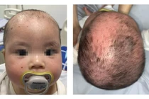 Tắm lá chữa viêm da đầu sai cách, trẻ 8 tháng bị bội nhiễm vi khuẩn nặng