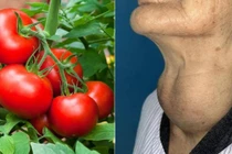 Bị bệnh tuyến giáp có nên ăn cà chua?