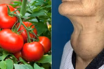 Bị bệnh tuyến giáp có nên ăn cà chua?