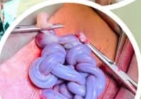 'Tết tóc' bằng dây rốn trong bụng mẹ và cuộc giải cứu kịp thời ở tuần 30