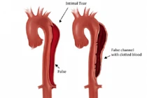  lóc tách động mạch chủ ngực vỡ