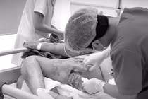 Tự chích mụn, cụ ông sốc nhiễm trùng huyết, hoại tử vùng mông đùi