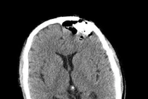 Vỡ lún xương sọ, suýt mất mạng chỉ vì quên đội mũ bảo hộ