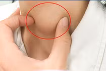 Mới 13 tuổi đã ung thư tuyến giáp, cảnh báo ở trẻ nhỏ