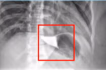 Điều trị thành công ca bệnh co thắt tâm vị không nuốt được