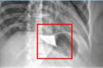 Điều trị thành công ca bệnh co thắt tâm vị không nuốt được