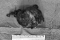 Phẫu thuật thành công khối u thận “khổng lồ” xâm lấn tĩnh mạch chủ dưới