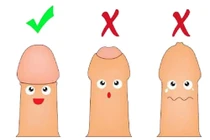 Nhiều hệ lụy khi cố lột bao quy đầu cho trẻ dưới 3 tuổi