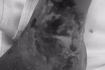 Chân hoại tử nặng vì đắp thuốc nam chữa rắn cắn