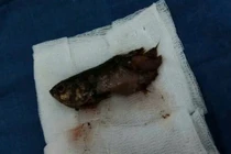 Bé trai 4 tuổi bị cá rô chui tọt vào cổ họng