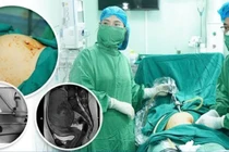 3 năm không chữa, u xơ tử cung phát triển như thai 4 tháng