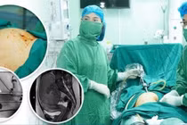 3 năm không chữa, u xơ tử cung phát triển như thai 4 tháng