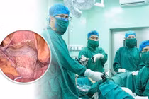 Cụ bà 76 tuổi bị sa sinh dục ra ngoài tử cung