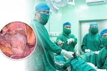 Cụ bà 76 tuổi bị sa sinh dục ra ngoài tử cung