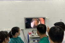 Nội soi gắp bàn chải đánh răng trong dạ dày nam thanh niên 