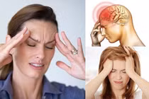 Đau nửa đầu Migraine tiềm ẩn nguy cơ đột quỵ não