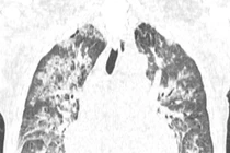 Tổn thương phổi gây tử vong hàng đầu ở người truyền máu, cách gì phòng tránh?