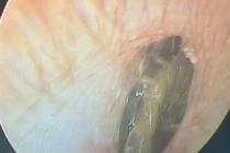 Hy hữu lấy thành công con rết sống trong tai người đàn ông 33 tuổi