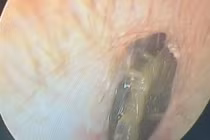 Hy hữu lấy thành công con rết sống trong tai người đàn ông 33 tuổi