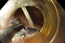 Đau bụng liên tục không ngờ xương cá 3 cm đâm dạ dày