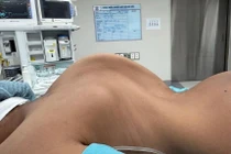 2 bé gái cao thêm 10 cm nhờ phẫu thuật chỉnh gù vẹo cột sống nặng hiếm gặp