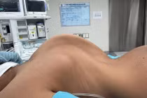 2 bé gái cao thêm 10 cm nhờ phẫu thuật chỉnh gù vẹo cột sống nặng hiếm gặp