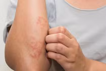 Lấy xong ổ giun lươn đã hết bệnh?