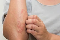 Lấy xong ổ giun lươn đã hết bệnh?