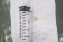 Bác sĩ mách cách xử lý dị vật đường thở tránh tử vong