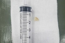 Bác sĩ mách cách xử lý dị vật đường thở tránh tử vong