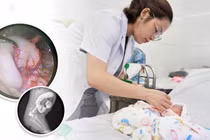 Chậm đi phân su, trẻ sơ sinh không ngờ phải mổ phình đại tràng bẩm sinh