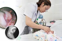 Chậm đi phân su, trẻ sơ sinh không ngờ phải mổ phình đại tràng bẩm sinh