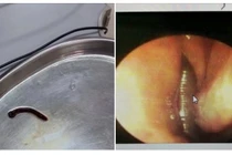 Tắm suối trẻ 9 tuổi ở Quảng Ninh bị đỉa rừng 4 cm trú ngụ trong mũi