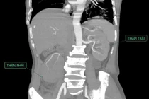 Cứu người bệnh xơ gan viêm thận bể thận nguy kịch