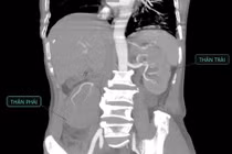 Cứu người bệnh xơ gan viêm thận bể thận nguy kịch