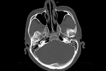 Chấn thương sọ não ở người cao tuổi, tưởng nhẹ, hậu quả có thể tử vong