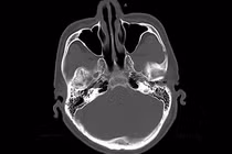 Chấn thương sọ não ở người cao tuổi, tưởng nhẹ, hậu quả có thể tử vong