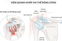 Địa chỉ vàng: Bệnh viện, phòng khám chẩn đoán tốt bệnh đau vai gáy