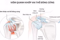 Địa chỉ vàng: Bệnh viện, phòng khám chẩn đoán tốt bệnh đau vai gáy