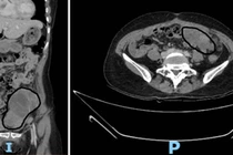Bệnh nhân nữ 48 tuổi bị nhiều khối u tái phát trong ổ bụng vì không tái khám