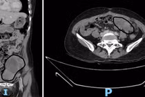 Bệnh nhân nữ 48 tuổi bị nhiều khối u tái phát trong ổ bụng vì không tái khám