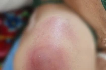 Hàng loạt ca áp xe liên quan đến tiêm truyền ở cơ sở không đảm bảo