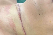 Bị dây thép trên đường cứa ngang cổ nguy kịch khi đi xe máy