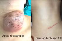 U nang vùng cổ rò xoang lê thường gặp ở trẻ, dễ tái phát
