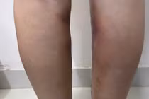 Chân biến dạng, nguy cơ hoại tử vì tiêm filler làm thẳng chân tại nhà